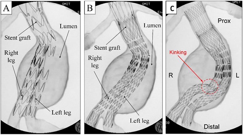 Deployment test of two different stent-grafts under fluoroscopy (A and B). Resulted kinking during testing (C).